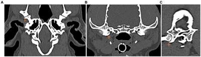 Morphological and morphometric measurement of the temporomandibular joint of small and medium-weight dogs with different skull shapes